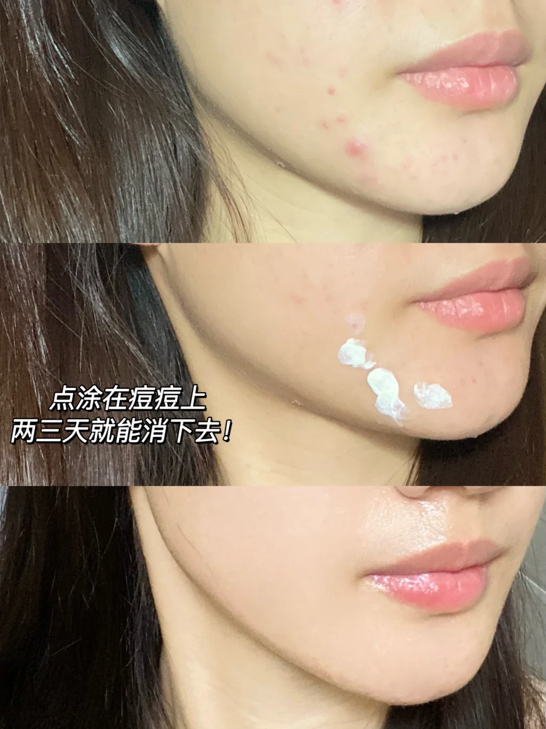 Tiktok/Douyin Hot BIGDROP Precision Acne Spot Serum 10ml 【Tiktok抖音爆款】大水滴精准祛痘点涂精华液