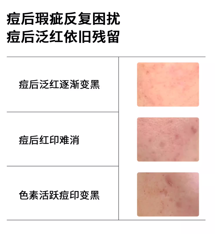 Tiktok/Douyin Hot FANKEQING 15% Azelaic Acid Clarifying Expert Emulsion 15g 【Tiktok抖音爆款】梵可清15%壬二酸净颜专研乳